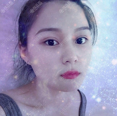 西安yestar宋蔚双眼皮案例 西安yestar宋蔚双眼皮案例