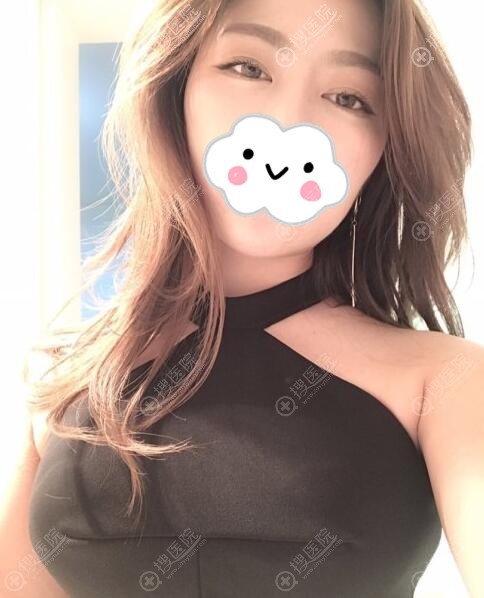<!--<i data=20240710 data-id=11218></i>-->曼托假体隆胸术后真实恢复效果图片 <!--<i data=20240710 data-id=11218></i>-->曼托假体隆胸术后真实恢复效果图片