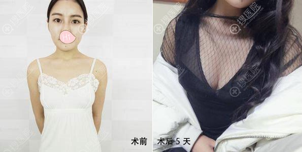 重庆红颜拜博做完自体脂肪隆胸后腿也瘦了,一举两得