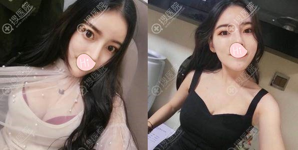 自体脂肪隆胸恢复后效果图 自体脂肪隆胸恢复后效果图
