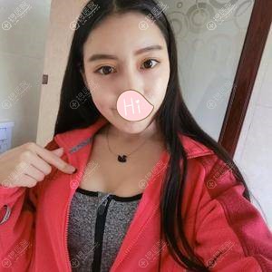 <!--<i data=20240710 data-id=11039></i>-->自体脂肪隆胸恢复图 <!--<i data=20240710 data-id=11039></i>-->自体脂肪隆胸恢复图