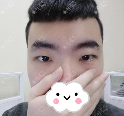 东莞知美割双眼皮怎么样?黄双闻眼综合案例与2019优惠价格