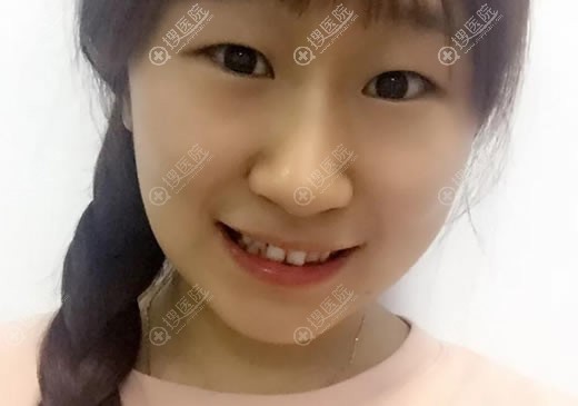找北京悦芳亚医疗美容王文明做双眼皮和开眼角2个月效果出来了