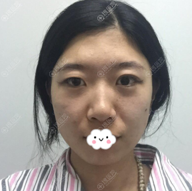 ����Ԫ���¾��轺���°�+¡��+����֬���沿���+˫��Ƥ���˰���