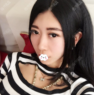 ����Ԫ��¡��+����֬���沿���+˫��Ƥ����