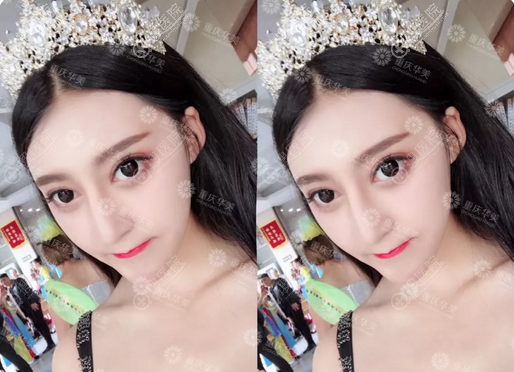 重庆华美达芬奇定制美眼和达拉斯肋骨鼻多少钱?6800元起附案例