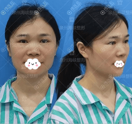 泉州丰泽海峡整形美容医院美容师肋软骨综合隆鼻的手术全过程