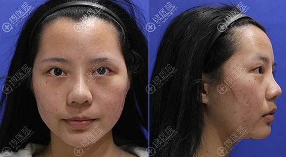 这就是我双11在北京惠合嘉美齐敏院长手下做隆鼻和双眼皮效果