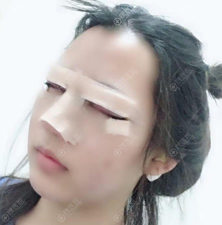 刚做完膨体隆鼻和双眼皮图片 刚做完膨体隆鼻和双眼皮图片