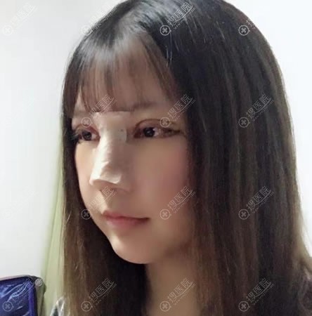 做完假体隆鼻和双眼皮7天后 做完假体隆鼻和双眼皮7天后