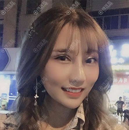 在北京惠和嘉美做双眼皮隆鼻15天后 在北京惠和嘉美做双眼皮隆鼻15天后