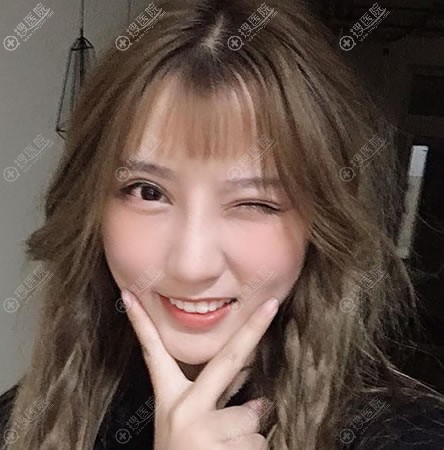 北京惠合嘉美双眼皮和隆鼻案例 北京惠合嘉美双眼皮和隆鼻案例