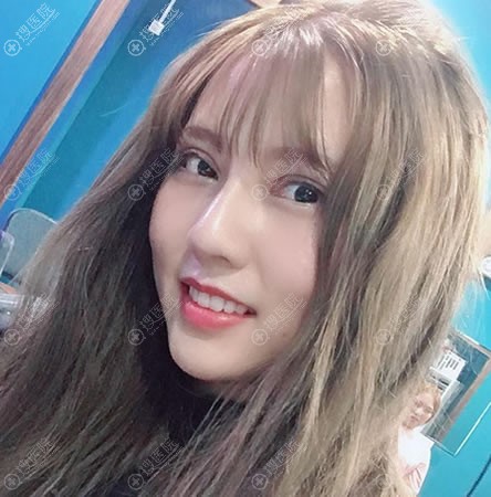 北京惠合嘉美隆鼻和双眼皮案例 北京惠合嘉美隆鼻和双眼皮案例