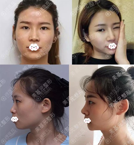 武汉美基元汪福强鼻综合隆鼻案例效果图 武汉美基元汪福强鼻综合隆鼻案例效果图