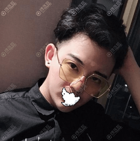 韩式半双眼皮变内双 韩式半双眼皮变内双