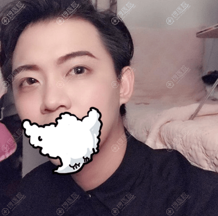 2年前做韩式双眼皮后效果 2年前做韩式双眼皮后效果