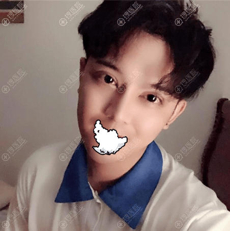 全切双眼皮术后2周恢复效果 全切双眼皮术后2周恢复效果