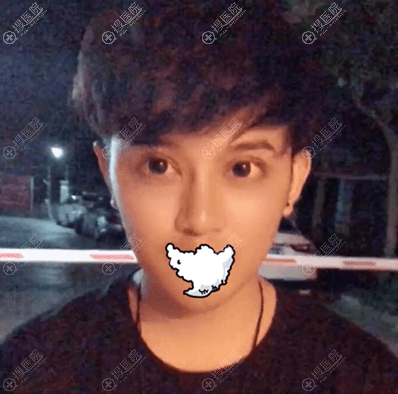 深圳禾丽全切双眼皮一个半月后效果 深圳禾丽全切双眼皮一个半月后效果