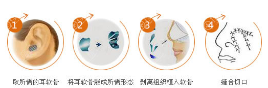 深圳格美黄印资教授解说耳软骨隆鼻能保持终身吗?多久恢复期?