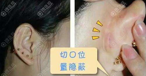 耳软骨取出后耳部疤痕 耳软骨取出后耳部疤痕