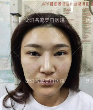 整形术前照片 整形术前照片