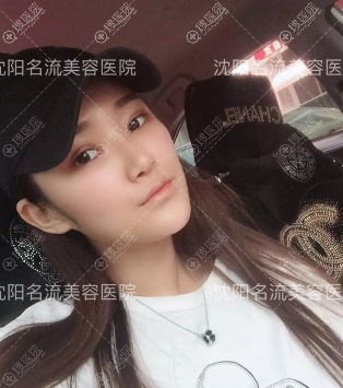 沈阳名流做双眼皮隆鼻怎么样 沈阳名流做双眼皮隆鼻怎么样