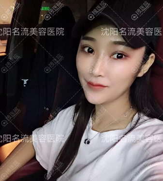 沈阳名流何鸿智双眼皮隆鼻案例 沈阳名流何鸿智双眼皮隆鼻案例