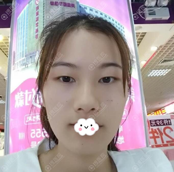 广州美恩陈宏彬割双眼皮怎么样?眼综合案例+面部填充图片费用