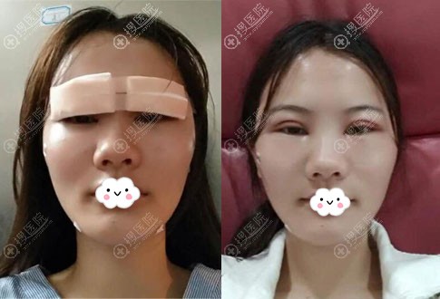 ���������º��˫��Ƥ+����֬���沿��������1��Ч��