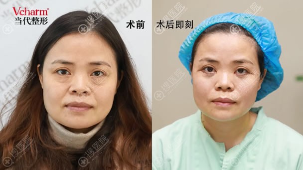 重庆当代邹大龙贝塔祛眼袋参赛案例作品 重庆当代邹大龙贝塔祛眼袋参赛案例作品