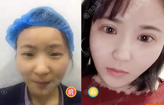 西安华医美陈晓丹双眼皮案例 西安华医美陈晓丹双眼皮案例