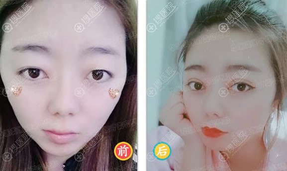 西安华医美陈晓丹双眼皮和美肤案例 西安华医美陈晓丹双眼皮和美肤案例