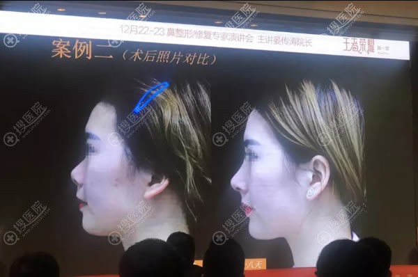 赣州华美晏传涛院长分享隆鼻案例 赣州华美晏传涛院长分享隆鼻案例