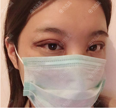 <!--<i data=20240710 data-id=12144></i>-->沈阳案例术后两天 <!--<i data=20240710 data-id=12144></i>-->沈阳案例术后两天