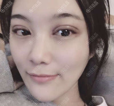 <!--<i data=20240710 data-id=12144></i>-->做双眼皮怎么样 <!--<i data=20240710 data-id=12144></i>-->做双眼皮怎么样