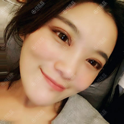 <!--<i data=20240710 data-id=12144></i>-->张超做的双眼皮案例10天图片 <!--<i data=20240710 data-id=12144></i>-->张超做的双眼皮案例10天图片