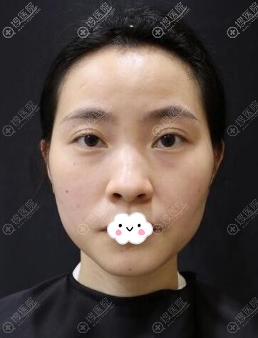 重庆面部线雕哪里好?重庆郑荃丽格周业松全脸埋线提升案例效果