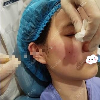 重庆郑荃丽格周业松线雕手术真实效果图 重庆郑荃丽格周业松线雕手术真实效果图