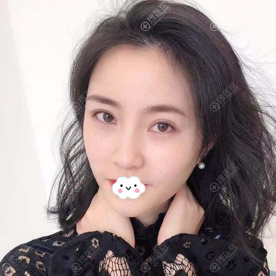 重庆郑荃丽格周业松面部埋线提升术后6天效果 重庆郑荃丽格周业松面部埋线提升术后6天效果