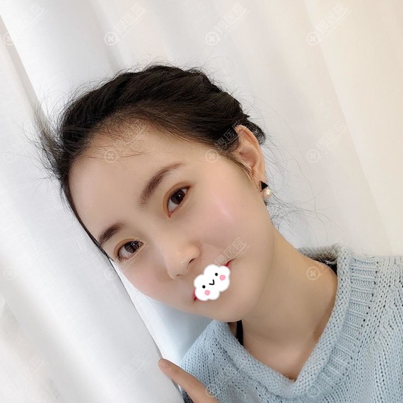 重庆郑荃丽格周业松面部线雕埋线提升术后效果图 重庆郑荃丽格周业松面部线雕埋线提升术后效果图