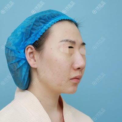 在北京延世做面部线雕提升后才知道这么做可以延长效果维持时间