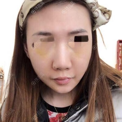 做完面部线雕4天恢复效果图 做完面部线雕4天恢复效果图