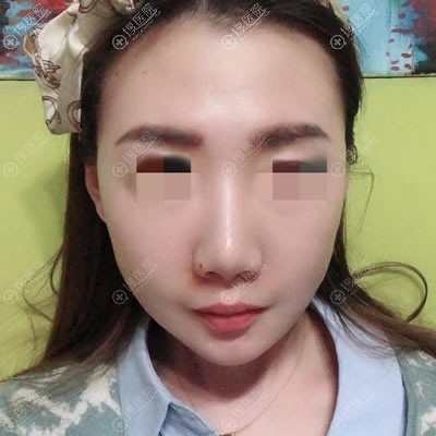 <!--<i data=20240710 data-id=12728></i>-->金惠燕线雕案例15天效果 <!--<i data=20240710 data-id=12728></i>-->金惠燕线雕案例15天效果