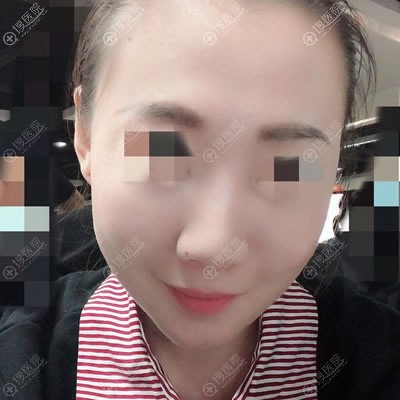 <!--<i data=20240710 data-id=12728></i>-->做完线雕一个月的照片 <!--<i data=20240710 data-id=12728></i>-->做完线雕一个月的照片