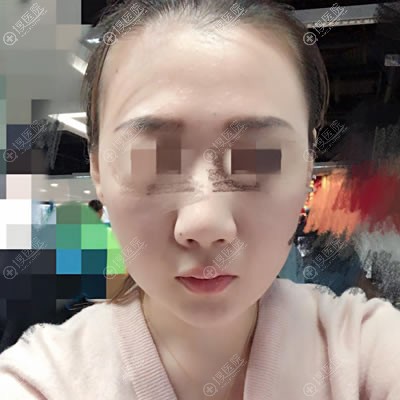 在<!--<i data=20240710 data-id=12728></i>-->做面部线雕2月后 在<!--<i data=20240710 data-id=12728></i>-->做面部线雕2月后