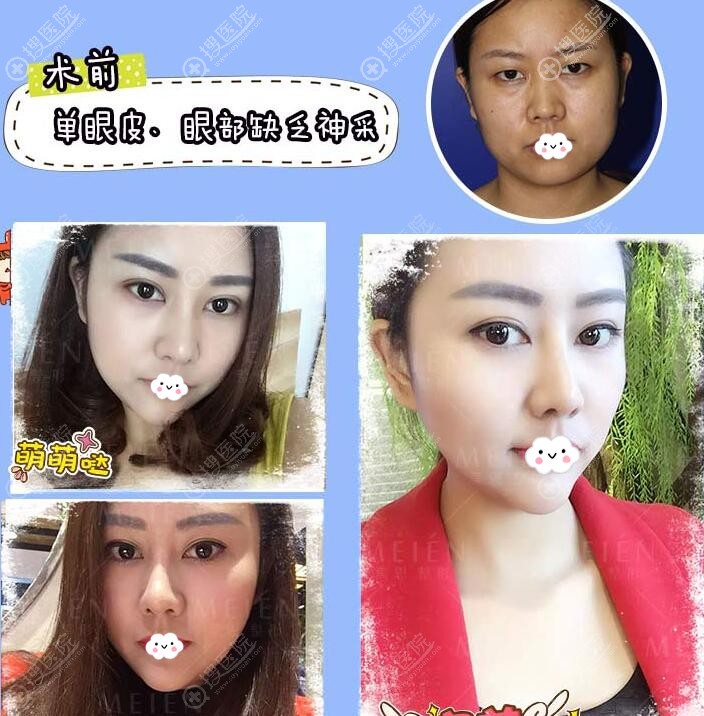 广州美恩雷涛院长精雕双眼皮案例前后效果对比图 广州美恩雷涛院长精雕双眼皮案例前后效果对比图