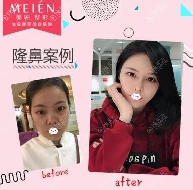 广东美恩沈绍勇鼻综合隆鼻案例效果对比图 广东美恩沈绍勇鼻综合隆鼻案例效果对比图