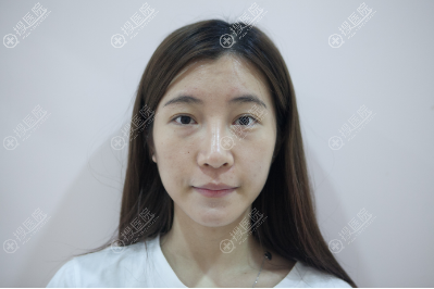 上海脂肪填充哪家好?看上海艺星李建兵面部脂肪填充案例就知道