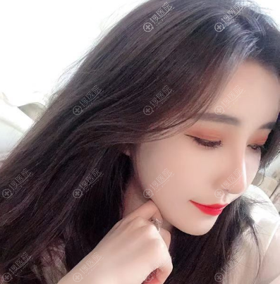 <!--<i data=20240710 data-id=12757></i>-->李建兵做的面部脂肪填充案例 <!--<i data=20240710 data-id=12757></i>-->李建兵做的面部脂肪填充案例