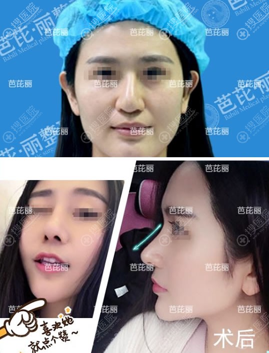 南宁芭芘丽鼻综合隆鼻案例 南宁芭芘丽鼻综合隆鼻案例